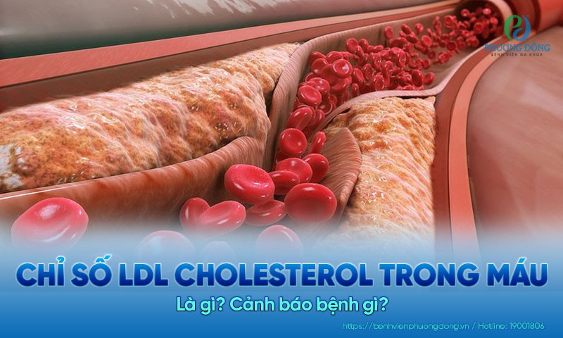 Chỉ số LDL Cholesterol trong máu là gì? Cảnh báo bệnh gì?