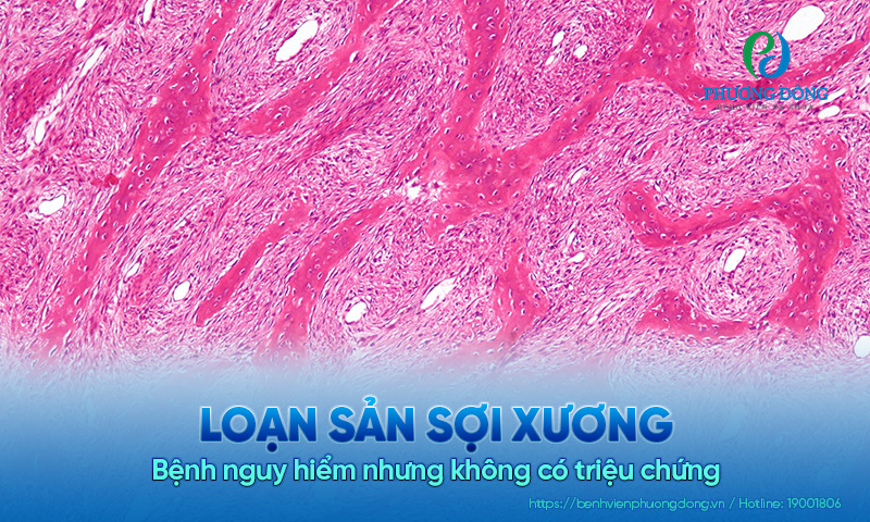 Loạn sản sợi xương - Bệnh nguy hiểm nhưng không có triệu chứng