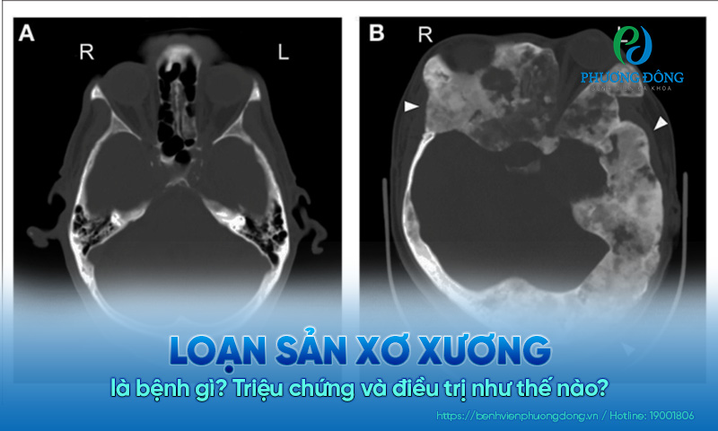Loạn sản xơ xương là bệnh gì? Triệu chứng và điều trị như thế nào?