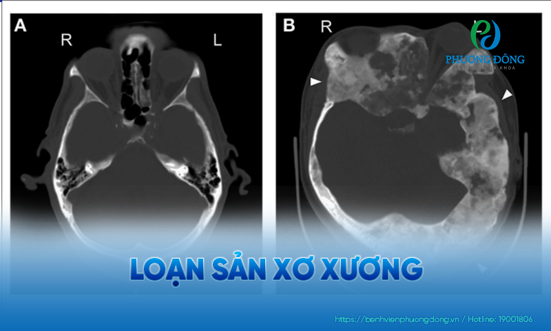 Hình chụp X Quang sọ của bệnh nhân bị rối loạn phát triển xương