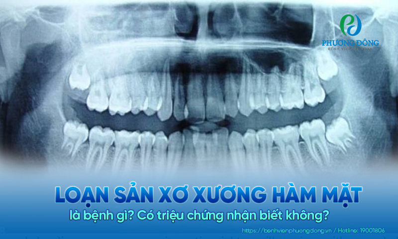 Loạn sản xơ xương hàm mặt là bệnh gì? Có triệu chứng nhận biết không?