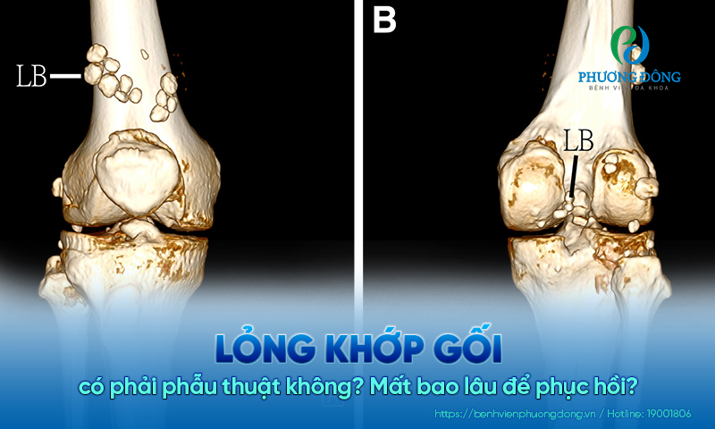 Lỏng khớp gối có phải phẫu thuật không? Mất bao lâu để phục hồi?