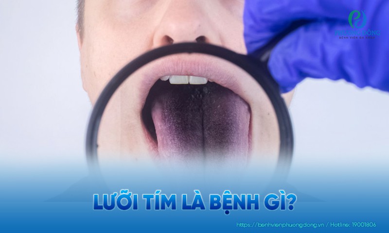 Lưỡi tím là bệnh gì? Các nhóm bệnh lý liên quan thường gặp