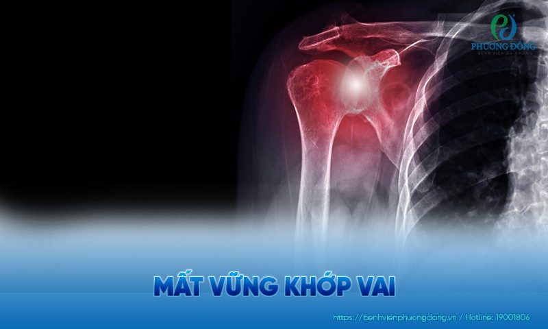 Mất vững khớp vai: Nguyên nhân, điều trị và biện pháp phòng ngừa