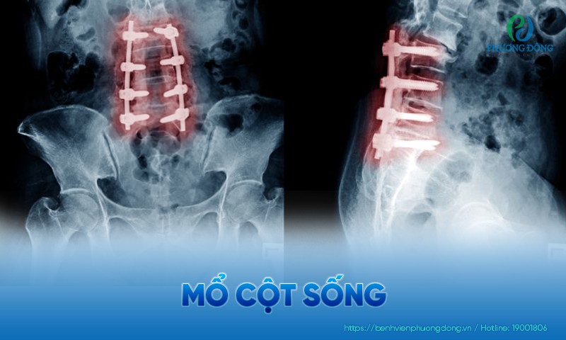 Mổ cột sống: Chỉ định khi nào? Các phương pháp phẫu thuật an toàn