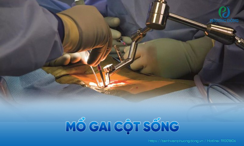 Mổ gai cột sống có nguy hiểm không? Chi phí phẫu thuật