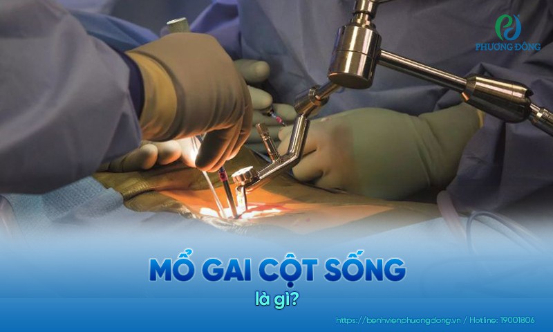 Những trường hợp gai cột sống được chỉ định phẫu thuật