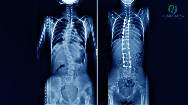 Các biến chứng có thể xảy ra sau khi mổ gai cột sống