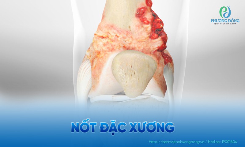 Nốt đặc xương là gì? Triệu chứng, nguyên nhân và điều trị