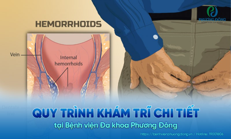 Quy trình khám trĩ chi tiết – Bệnh viện Đa khoa Phương Đông