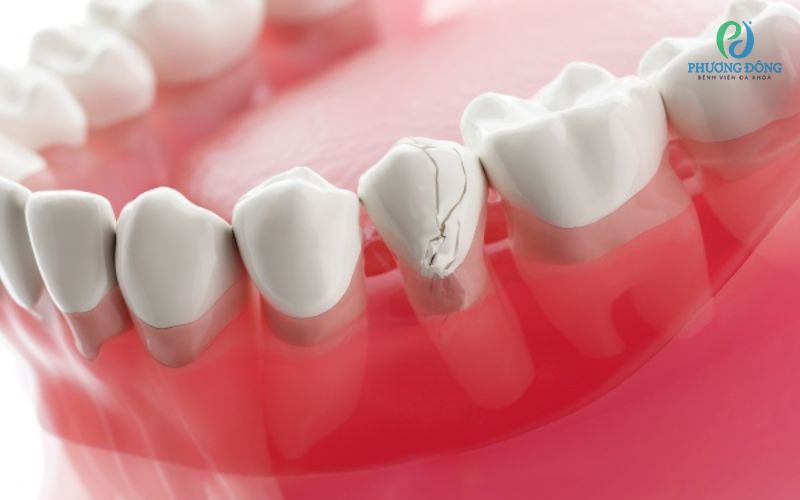 Răng bị nứt có sao không? Cách khắc phục tình trạng răng nứt vỡ