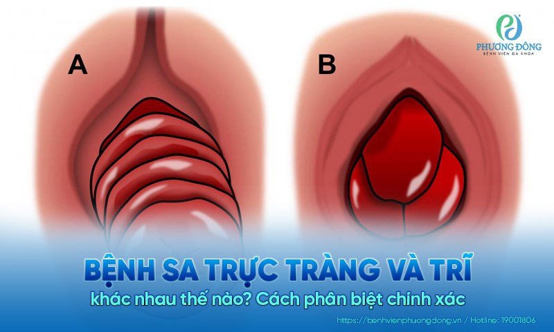 Sa trực tràng và trĩ khác nhau thế nào? Cách phân biệt chính xác