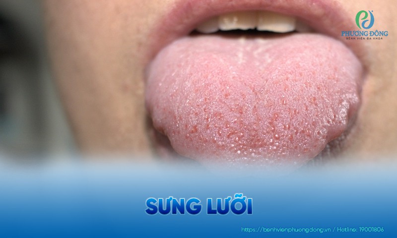 Sưng lưỡi: Triệu chứng, nguyên nhân và phương pháp điều trị