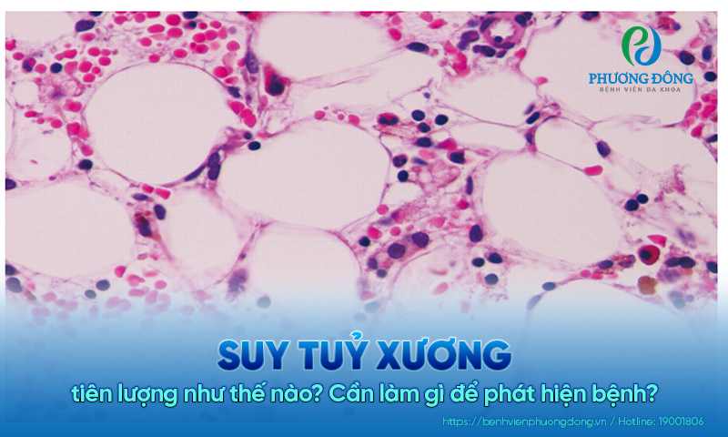 Suy tủy xương tiên lượng như thế nào? Cần làm gì để phát hiện bệnh?