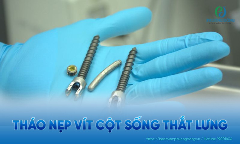 Tháo nẹp vít cột sống thắt lưng khi nào? Quy trình kỹ thuật