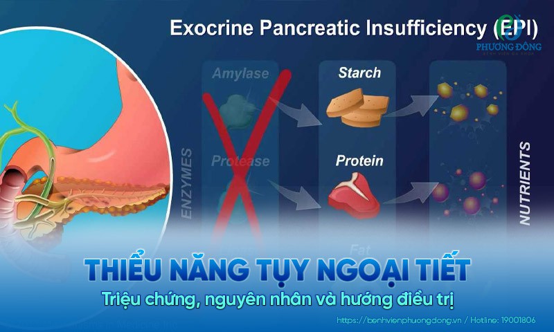 Thiểu năng tụy ngoại tiết: Triệu chứng, nguyên nhân và hướng điều trị