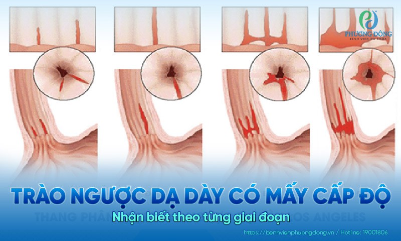 Trào ngược dạ dày có mấy cấp độ? Nhận biết theo từng giai đoạn