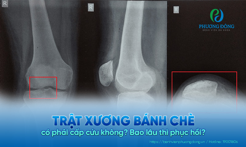 Trật xương bánh chè có phải cấp cứu không? Bao lâu thì phục hồi?