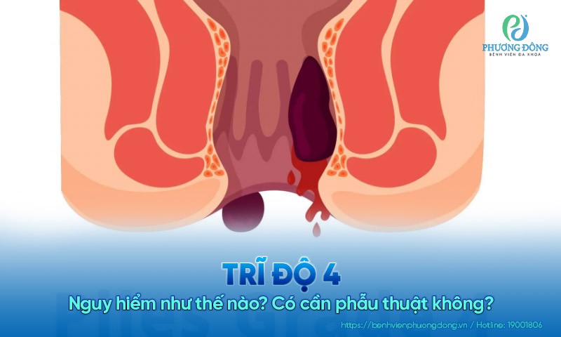 Trĩ độ 4 nguy hiểm như thế nào? Có cần phẫu thuật không?