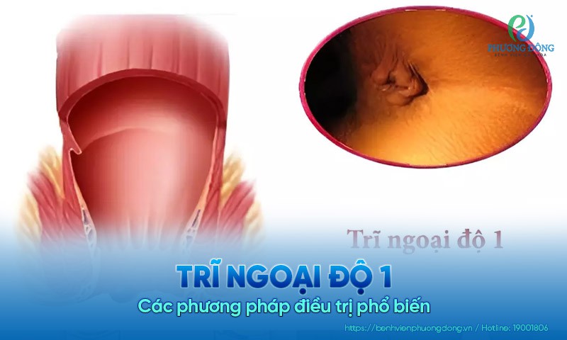 Trĩ ngoại độ 1: Các phương pháp điều trị phổ biến