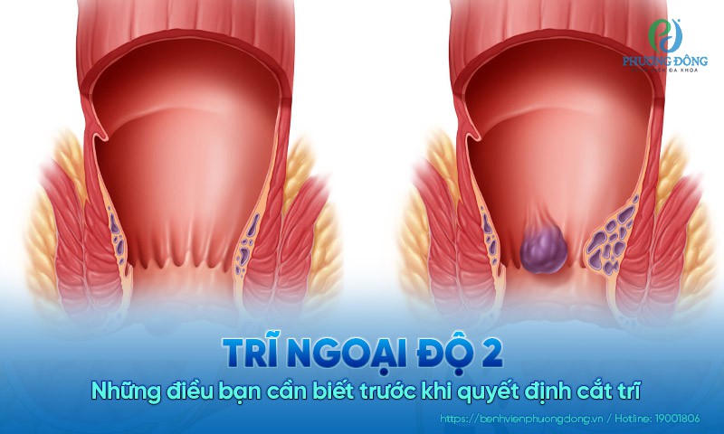 Trĩ ngoại độ 2: Những điều bạn cần biết trước khi quyết định cắt trĩ