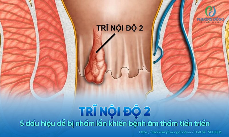 Trĩ nội độ 2: 5 dấu hiệu dễ bị nhầm lẫn khiến bệnh âm thầm tiến triển