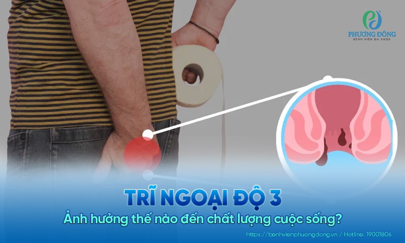 Trĩ ngoại độ 3 ảnh hưởng thế nào đến chất lượng cuộc sống?
