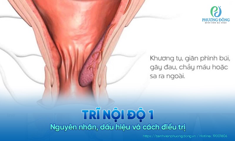 Trĩ nội độ 1 là gì? Nguyên nhân, dấu hiệu và cách điều trị