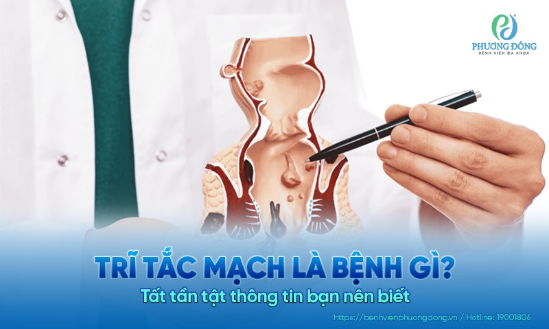 Trĩ tắc mạch là bệnh gì? Tất tần tật thông tin bạn nên biết