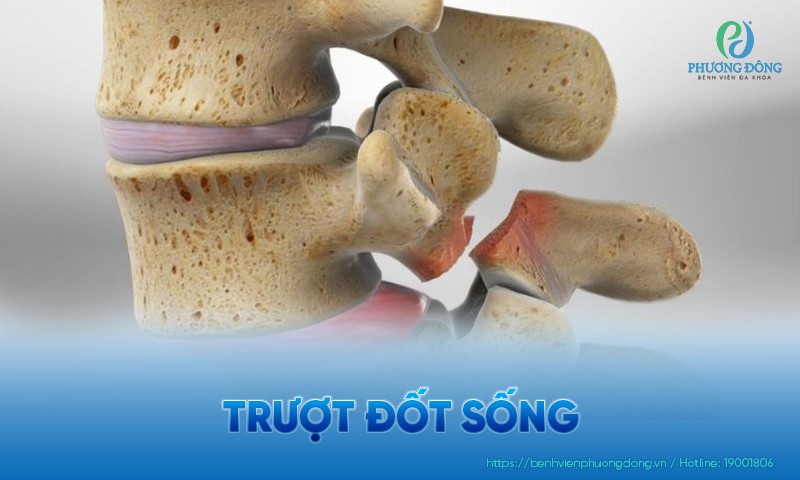 Trượt đốt sống: Nguyên nhân, triệu chứng và phương pháp điều trị