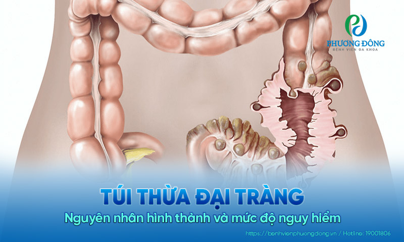 Túi thừa đại tràng là gì? Nguyên nhân hình thành và mức độ nguy hiểm