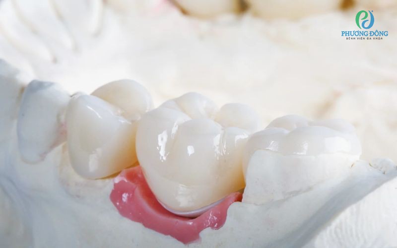 Tụt nướu là gì? Nguyên nhân, triệu chứng và cách điều trị