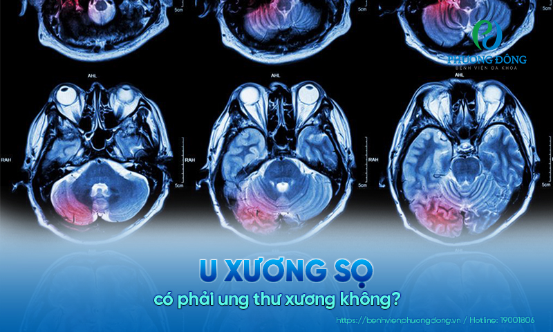 Giải đáp thắc mắc: U xương sọ có phải ung thư xương không?