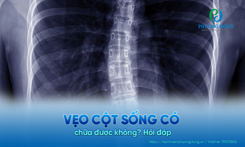 Hỏi đáp: Vẹo cột sống có chữa được không? Hỏi đáp: Vẹo cột sống có chữa được không?