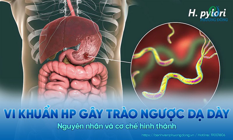 Vi khuẩn HP gây trào ngược dạ dày là gì? Nguyên nhân và cơ chế hình thành