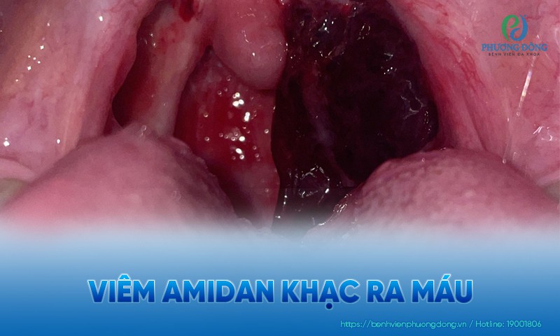Viêm amidan khạc ra máu​: Nguyên nhân và cách xử lý