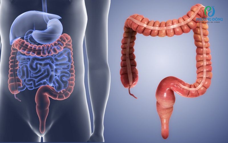Viêm đại tràng cấp tính: Nguyên nhân, triệu chứng và cách điều trị