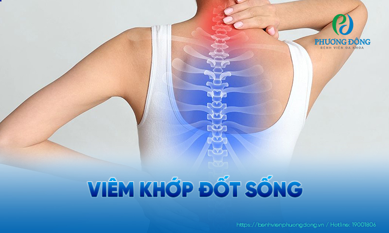 Các khớp ở đốt sống của bệnh nhân có thể bị viêm