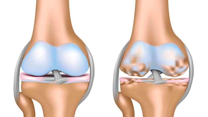 Khớp bị thoái hoá là nguyên nhân hàng đầu gây viêm khớp