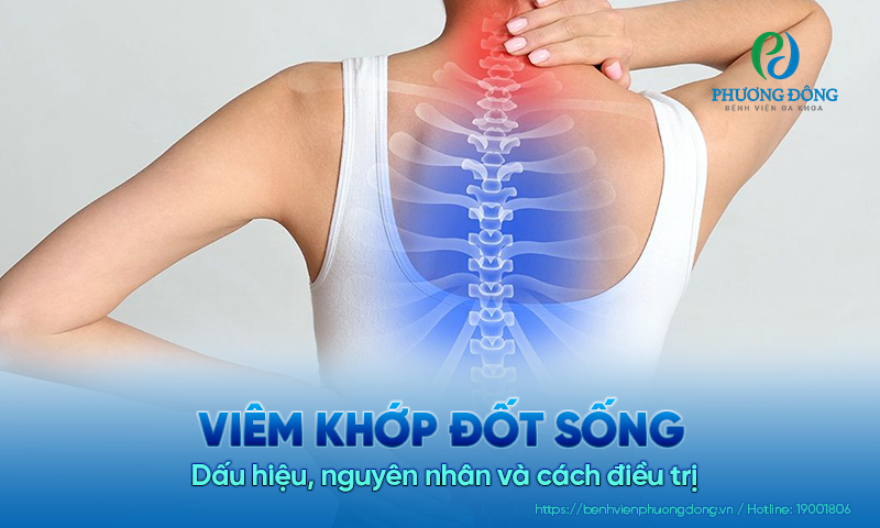 Viêm khớp đốt sống: Dấu hiệu, nguyên nhân và cách điều trị