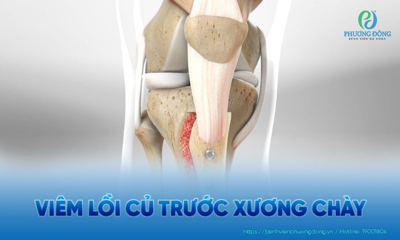 Viêm lồi củ trước xương chày: Triệu chứng, nguyên nhân và điều trị