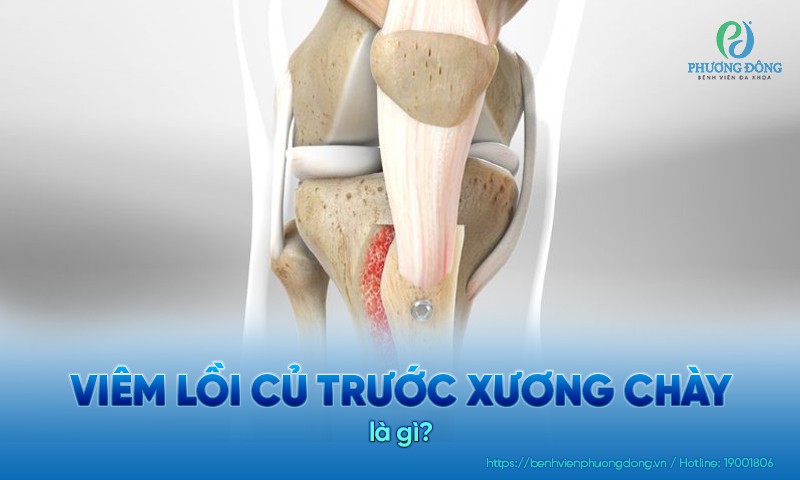 Viêm lồi củ trước xương chày là một dạng tổn thương mạn tính