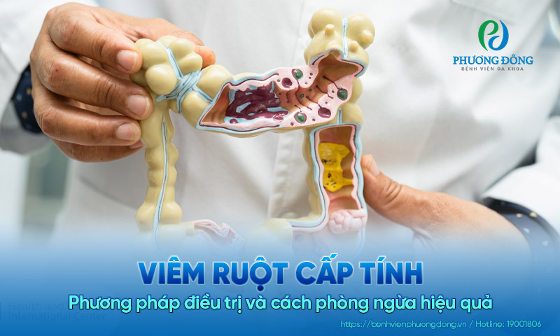 Viêm ruột cấp tính: Phương pháp điều trị và cách phòng ngừa hiệu quả