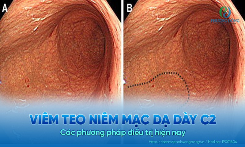 Viêm teo niêm mạc dạ dày c2: Các phương pháp điều trị hiện nay