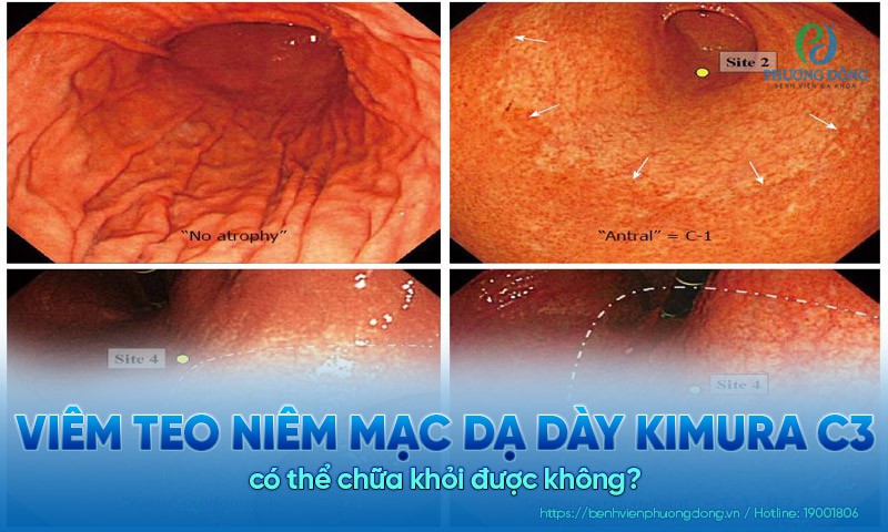 Viêm teo niêm mạc dạ dày Kimura c3 có thể chữa khỏi được không?
