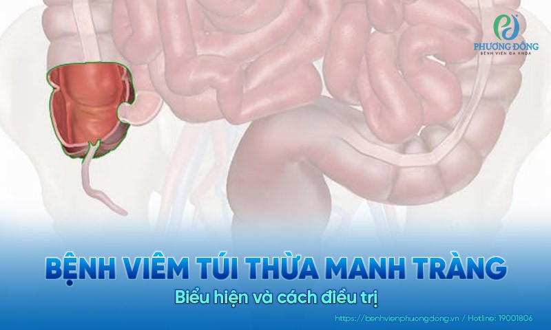 Bệnh viêm túi thừa manh tràng là gì? Biểu hiện và cách điều trị