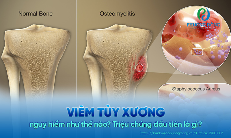 Viêm tủy xương nguy hiểm như thế nào? Triệu chứng đầu tiên là gì?