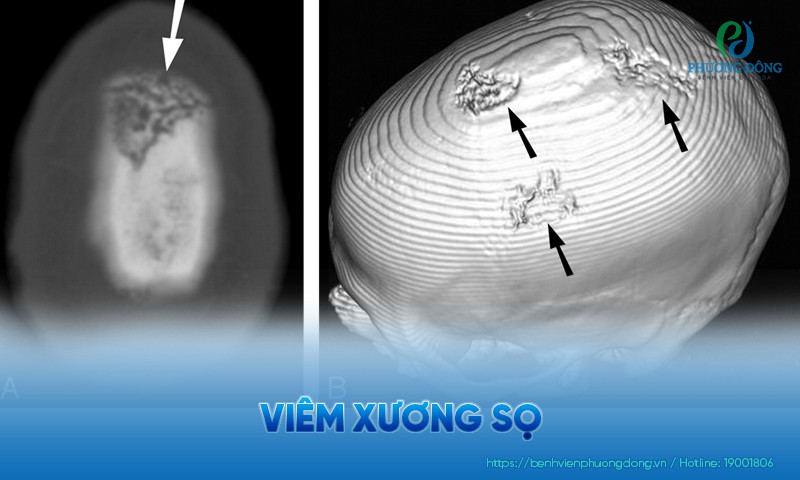 Viêm xương sọ: Triệu chứng, nguyên nhân và hướng điều trị