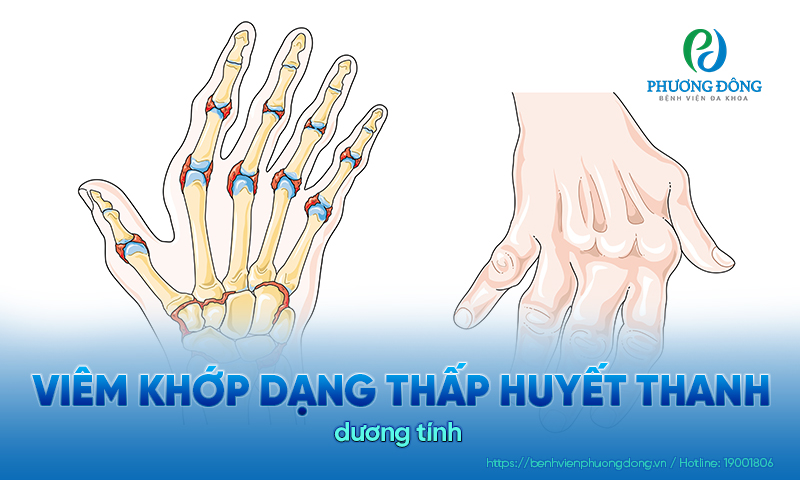 Viêm khớp dạng thấp huyết thanh dương tính là bệnh gì? Các nguyên nhân gây bệnh