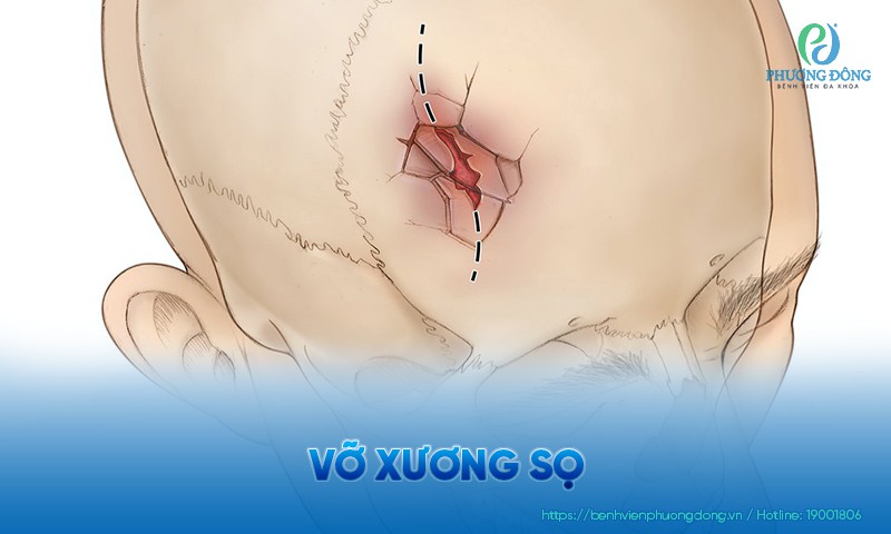 Vỡ xương sọ: Nguyên nhân, triệu chứng và cách điều trị